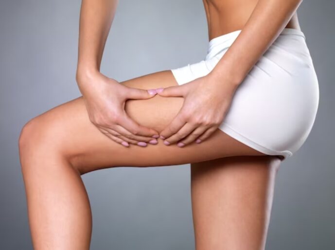 Cellulite Solutions: A Science-Backed Approach to Treatment